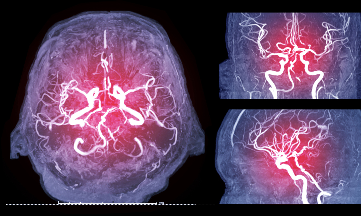 Collection of Magnetic resonance image (MRI) of Vessel in the brain axial , coronal and sagittal view or MRA brain.